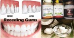 8 EASY HOME REMEDIES FOR RECEDING GUMS (AND PREVENT AN INFECTION)