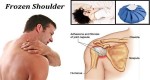 HOW TO FIND THE BEST NATURAL REMEDY TO CURE FROZEN SHOULDER