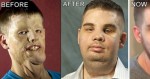 He Had The Most Extensive Face Transplant In History. 5 Years Later, He Looks Like THIS