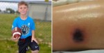 10-Year-Old Boy Dies 2 Weeks After This Strange Marking Appears On His Leg