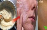 How To Get Rid of Large Pores And Acne Scars From Face