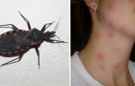 “Smooch” From This “Kissing Bug” Can Be Fatal For Your Health