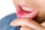 Cure Canker Sores FAST With These 8 Natural Remedies!