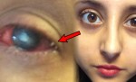 Teenager Kept Awake For Week To Stop Parasite Burrowing Into Eyeball