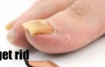 These Simple Steps Will Help You To Get Rid Of Foul Smelling Nail Fungus