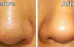 Check Out These Simple Steps To Remove Your Blackheads