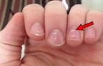 You Need To Consult Your Doctor Whenever You See These White Spots On Your Nails