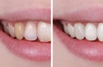 How To Make Your Teeth Whiter (Without Destroying Your Enamel)