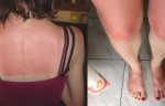 These Horrifying Sunburn Images Will Make You Fear From This Summer