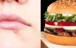 Be Aware! McDonald’s Burger Can Give You Lip Herpes