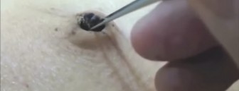 A disgusting stone the size of a prune pit gets pulled out of this person’s dirty belly button