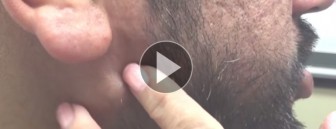 This man can thank his “popaholic” wife for the gush of relief he felt after this cyst burst