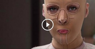 After A Crazed Woman Set Her On Fire, She Lived In A Mask For Two Years. This Is Her New Face.