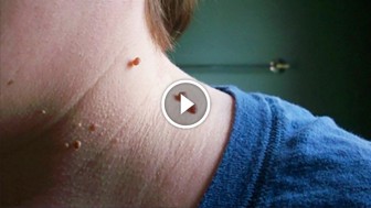 How To Get Rid Of Skin Tags Using One Simple Home Remedy! Amazing!