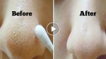 She hated her blackheads. What she did to get ride of them is awesome!
